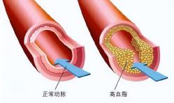 血脂大挑戰？降脂針：新時代的“降脂英雄”